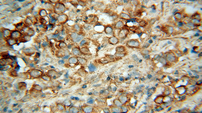 Immunohistochemical of paraffin-embedded human prostate cancer using Catalog No:108810(CDH7 antibody) at dilution of 1:50 (under 40x lens)