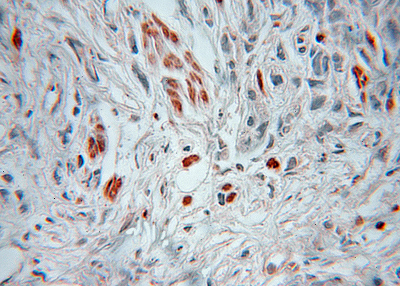 Immunohistochemical of paraffin-embedded human prostate cancer using Catalog No:111471(HSBP1 antibody) at dilution of 1:50 (under 10x lens)