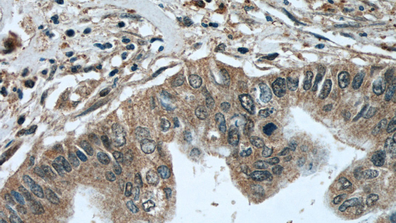 Immunohistochemical of paraffin-embedded human pancreas cancer using Catalog No:114894(RPL38 antibody) at dilution of 1:50 (under 40x lens)