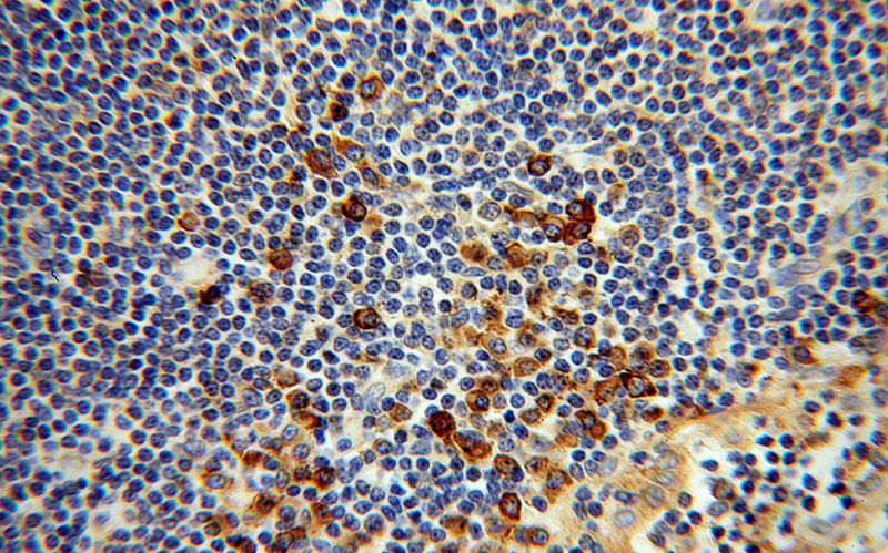 Immunohistochemical of paraffin-embedded human lymphoma using Catalog No:109674(PPIB antibody) at dilution of 1:100 (under 40x lens)