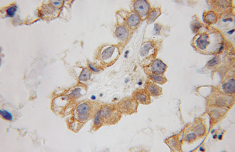 Immunohistochemical of paraffin-embedded human ovary tumor using Catalog No:109788(CYTH2 antibody) at dilution of 1:50 (under 40x lens)