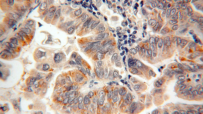 Immunohistochemical of paraffin-embedded human lung cancer using Catalog No:108842(CAPSL antibody) at dilution of 1:100 (under 40x lens)