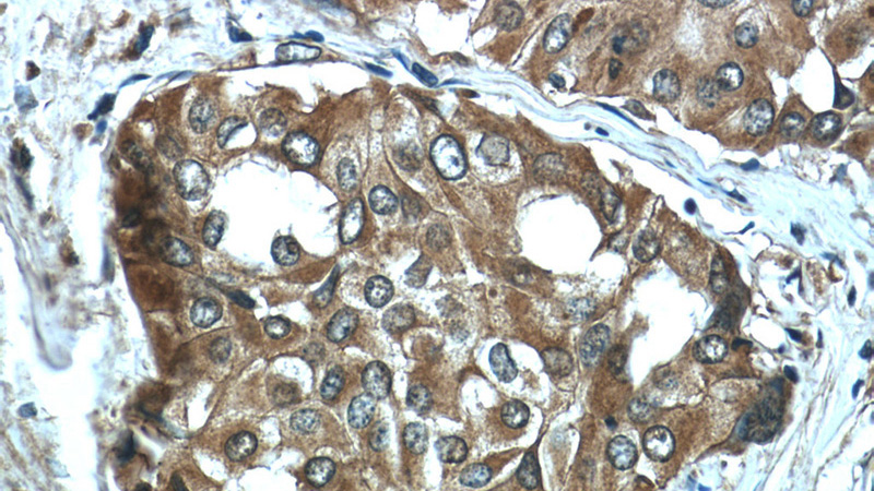 Immunohistochemistry of paraffin-embedded human thyroid cancer tissue slide using Catalog No:115496(SLC5A5 Antibody) at dilution of 1:50 (under 40x lens)