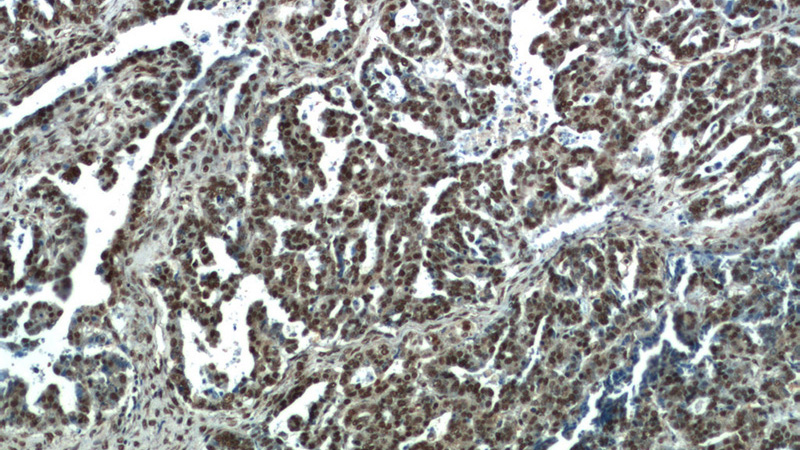 Immunohistochemistry of paraffin-embedded human ovary tumor tissue slide using Catalog No:110556(FBXO5 Antibody) at dilution of 1:50
