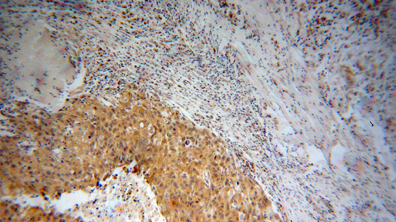 Immunohistochemical of paraffin-embedded human lung cancer using Catalog No:113246(NME1 antibody) at dilution of 1:100 (under 10x lens)