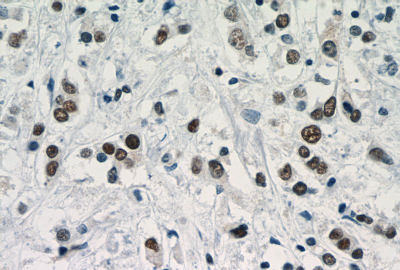Immunohistochemistry of paraffin-embedded human breast cancer slide using Catalog No:116069(TLE3 Antibody) at dilution of 1:50
