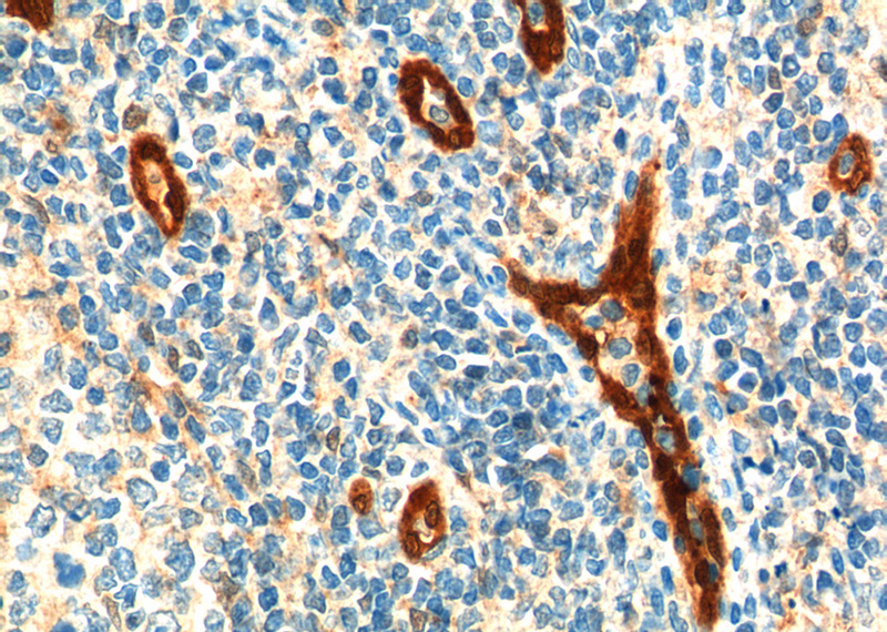 Immunohistochemistry of paraffin-embedded human tonsillitis tissue slide using Catalog No:107036(CCBP2 Antibody) at dilution of 1:400 (under 40x lens). heat mediated antigen retrieved with Tris-EDTA buffer(pH9).