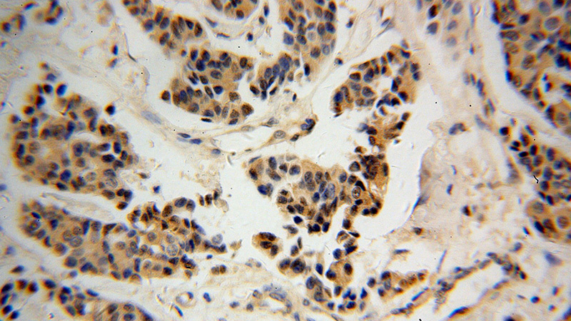 Immunohistochemical of paraffin-embedded human breast cancer using Catalog No:113053(NDE1 antibody) at dilution of 1:100 (under 40x lens)