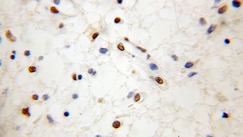 Immunohistochemical of paraffin-embedded human gliomas using Catalog No:115838(SUMO2/3 antibody) at dilution of 1:50 (under 10x lens)