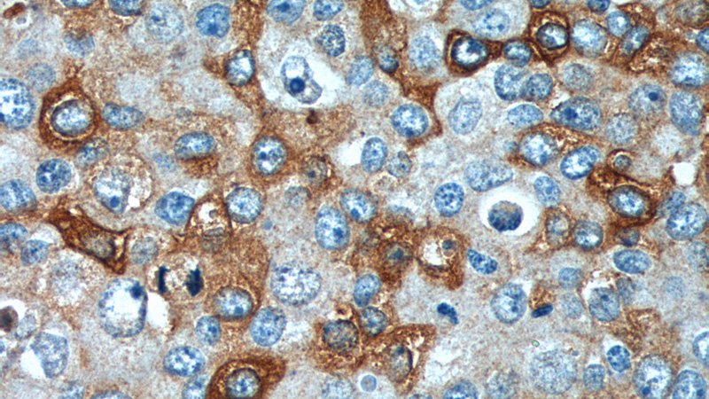 Immunohistochemistry of paraffin-embedded human breast cancer tissue slide using Catalog No:111661(IL13RA2,CD213A2 Antibody) at dilution of 1:200 (under 40x lens).