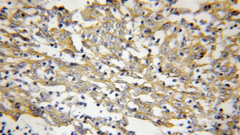 Immunohistochemical of paraffin-embedded human colon cancer using Catalog No:110669(FKBP10 antibody) at dilution of 1:50 (under 10x lens)