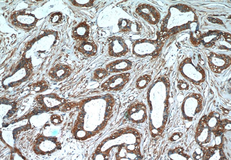 Immunohistochemistry of paraffin-embedded human breast cancer tissue slide using Catalog No:107292(GDI2 Antibody) at dilution of 1:50 (under 10x lens)