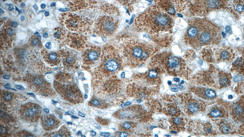 Immunohistochemistry of paraffin-embedded human hepatocirrhosis tissue slide using Catalog No:117201(BMP9 Antibody) at dilution of 1:50 (under 40x lens)
