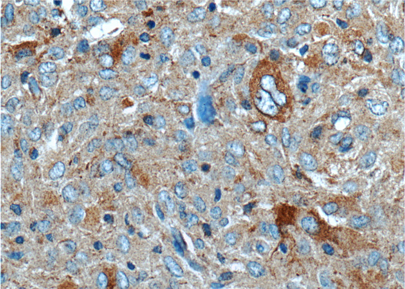 Immunohistochemistry of paraffin-embedded human gliomas tissue slide using Catalog No:113925(PLA2G4B Antibody) at dilution of 1:50 (under 40x lens)