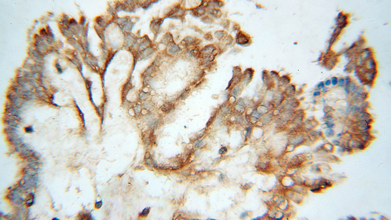 Immunohistochemical of paraffin-embedded human ovary tumor using Catalog No:107853(AIFM3 antibody) at dilution of 1:50 (under 40x lens)