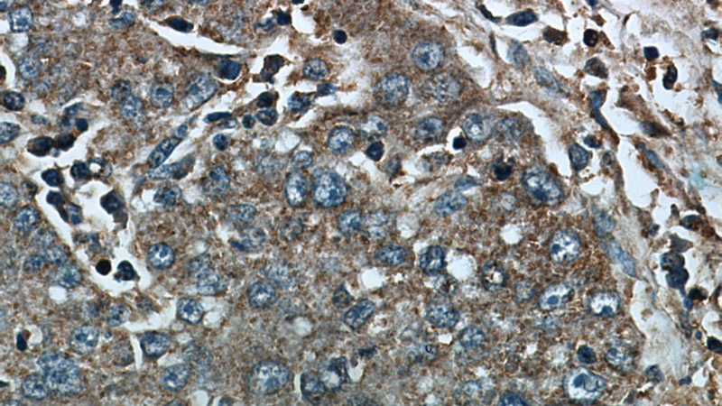 Immunohistochemical of paraffin-embedded human liver cancer using Catalog No:109083(CCT4 antibody) at dilution of 1:50 (under 40x lens)