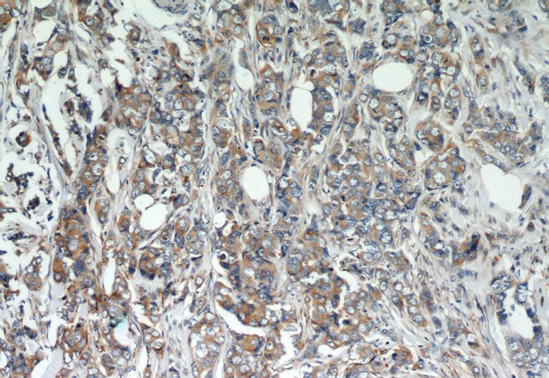 Immunohistochemistry of paraffin-embedded human breast cancer slide using Catalog No:108246(ARF4 Antibody) at dilution of 1:50 (under 10x lens)