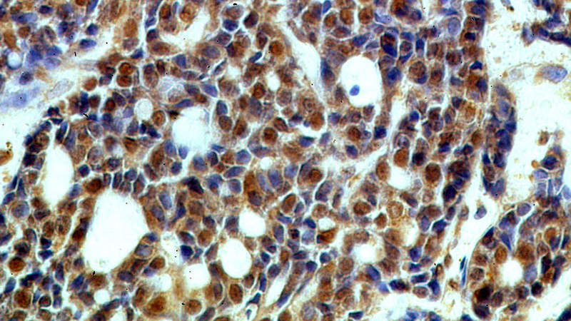 Immunohistochemical of paraffin-embedded human cervical cancer using Catalog No:115060(SAP18 antibody) at dilution of 1:50 (under 40x lens)