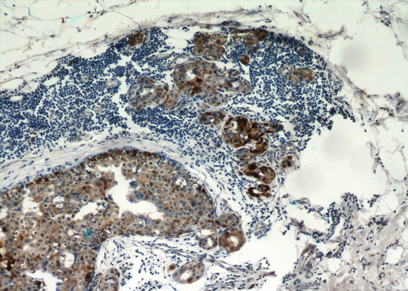 Immunohistochemical of paraffin-embedded human breast cancer using Catalog No:108861(CARM1 antibody) at dilution of 1:50 (under 10x lens)