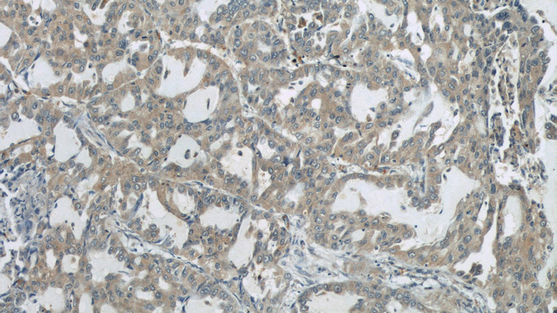 Immunohistochemistry of paraffin-embedded human lung cancer slide using Catalog No:107675(AARS2 Antibody) at dilution of 1:50