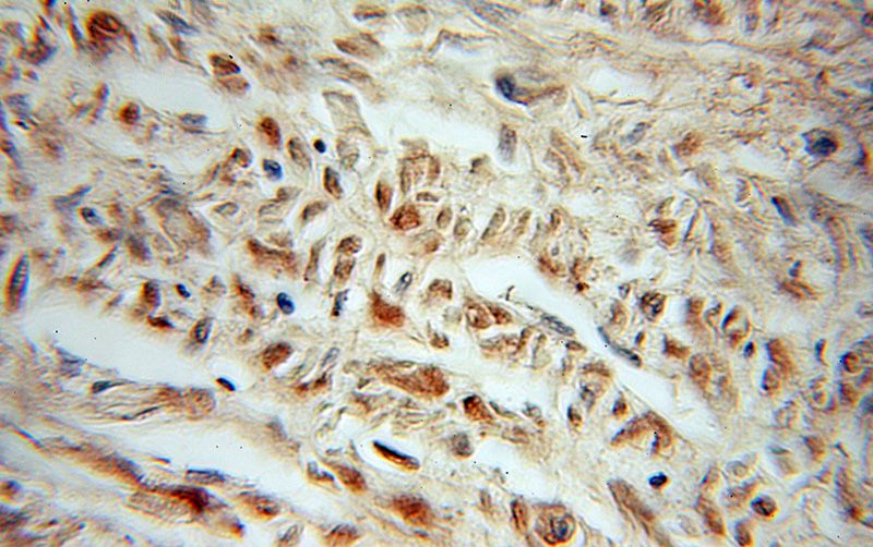 Immunohistochemical of paraffin-embedded human prostate cancer using Catalog No:112630(MEF2BNB antibody) at dilution of 1:10 (under 10x lens)