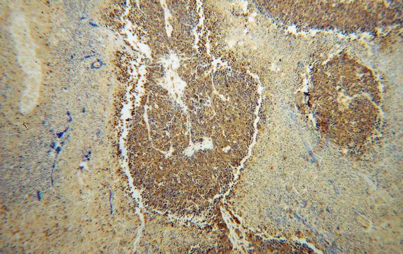 Immunohistochemical of paraffin-embedded human lung cancer using Catalog No:108863(CARS antibody) at dilution of 1:100 (under 10x lens)