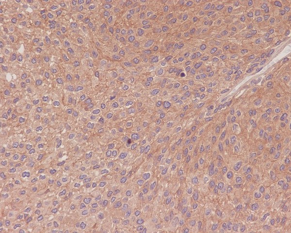 Immunohistochemical analysis of paraffin-embedded human transitional cell carcinoma of bladder, using NF-κB p65 Antibody.