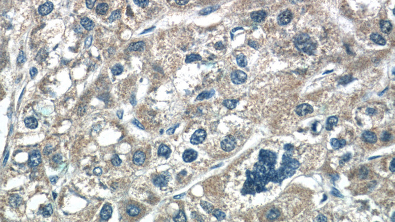 Immunohistochemistry of paraffin-embedded human liver cancer tissue slide using Catalog No:116632(C6orf125 Antibody) at dilution of 1:50 (under 40x lens)