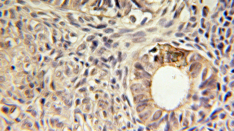 Immunohistochemical of paraffin-embedded human ovary tumor using Catalog No:116446(TSPAN15 antibody) at dilution of 1:100 (under 10x lens)