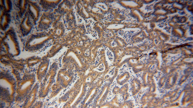 Immunohistochemical of paraffin-embedded human endometrial cancer using Catalog No:111573(HSPA1L antibody) at dilution of 1:100 (under 10x lens)