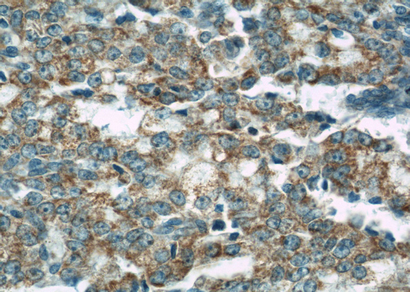 Immunohistochemical of paraffin-embedded human prostate cancer using Catalog No:107172(COXIV antibody) at dilution of 1:100 (under 40x lens)
