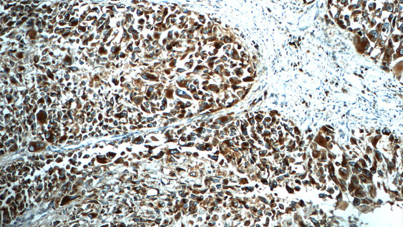 Immunohistochemistry of paraffin-embedded human malignant melanoma tissue slide using Catalog No:109133(CD63 Antibody) at dilution of 1:50 (under 10x lens)