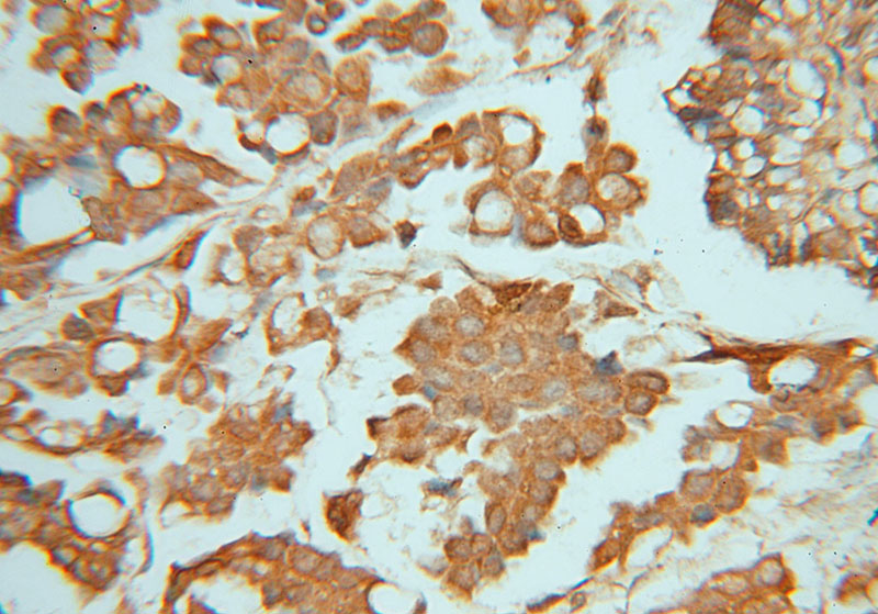 Immunohistochemical of paraffin-embedded human ovary tumor using Catalog No:113893(PIGK antibody) at dilution of 1:50 (under 40x lens)