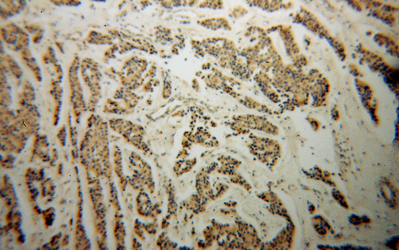Immunohistochemical of paraffin-embedded human breast cancer using Catalog No:113053(NDE1 antibody) at dilution of 1:100 (under 10x lens)