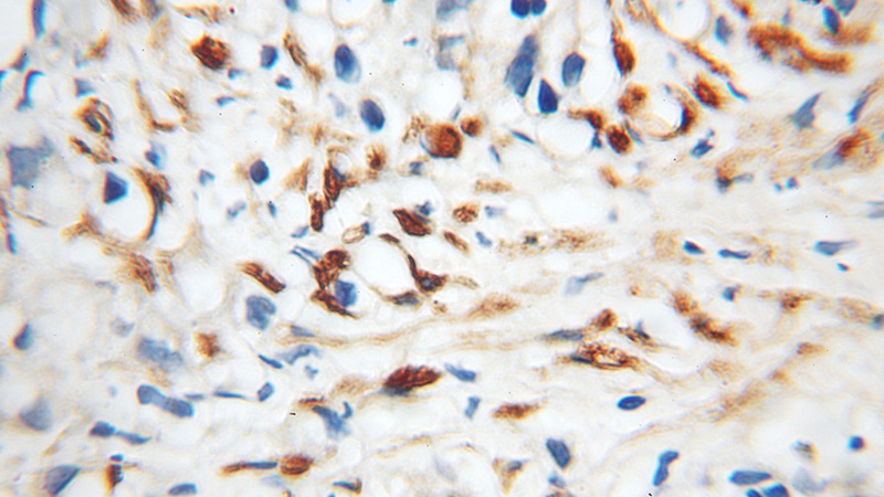 Immunohistochemical of paraffin-embedded human prostate cancer using Catalog No:117245(BRSK2 antibody) at dilution of 1:50 (under 10x lens)
