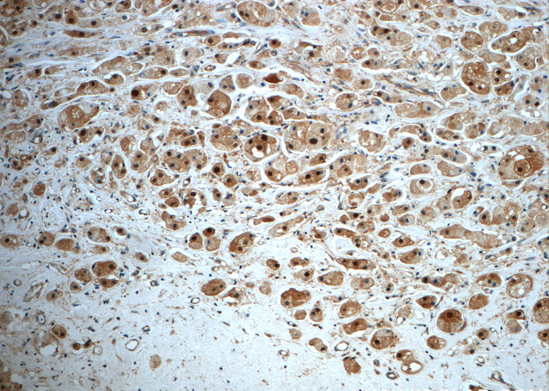 Immunohistochemistry of paraffin-embedded human breast cancer slide using Catalog No:115753(SUZ12 Antibody) at dilution of 1:50