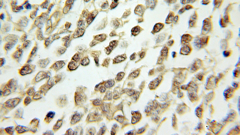 Immunohistochemical of paraffin-embedded human lymphoma using Catalog No:109097(CDC25B antibody) at dilution of 1:100 (under 10x lens)