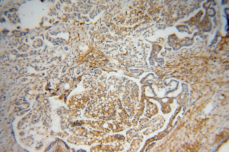 Immunohistochemical of paraffin-embedded human ovary tumor using Catalog No:112284(LMOD1 antibody) at dilution of 1:50 (under 10x lens)