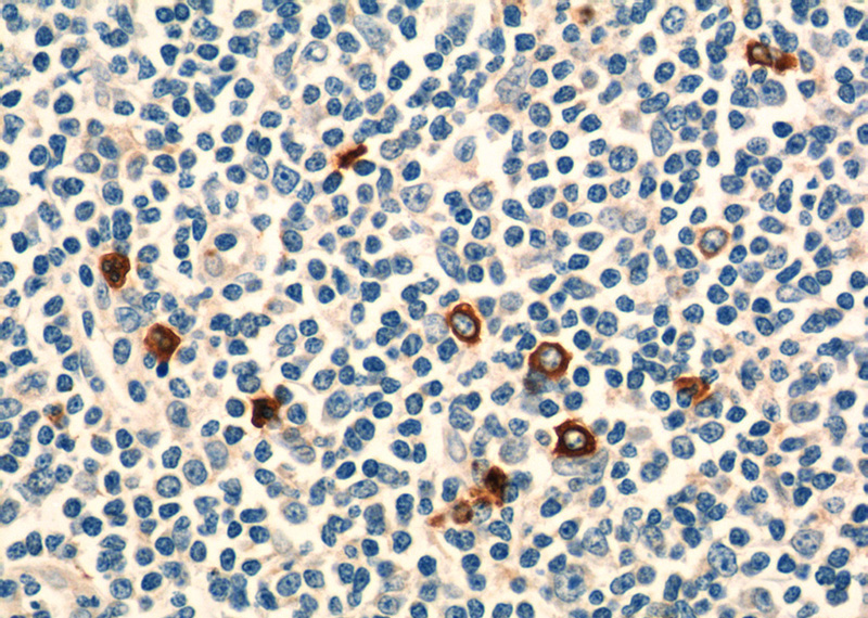 Immunohistochemistry of paraffin-embedded human tonsillitis tissue slide using Catalog No:112110(KLRF1 Antibody) at dilution of 1:50 (under 40x lens)