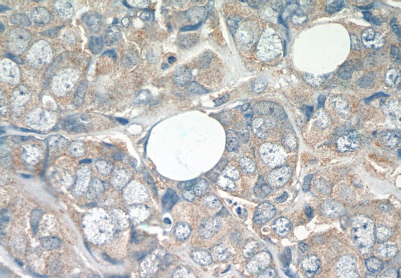Immunohistochemistry of paraffin-embedded human breast cancer tissue slide using Catalog No:108284(ATF2-Specific Antibody) at dilution of 1:50 (under 40x lens)