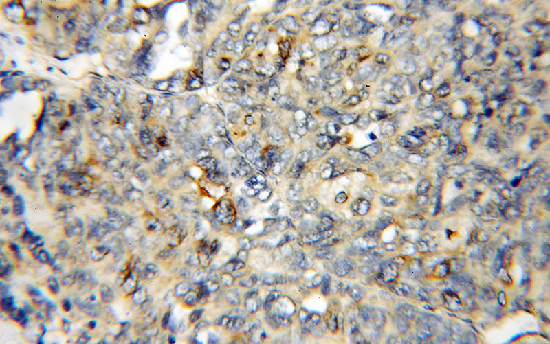 Immunohistochemical of paraffin-embedded human ovary tumor using Catalog No:110143(DYNLT3 antibody) at dilution of 1:50 (under 10x lens)
