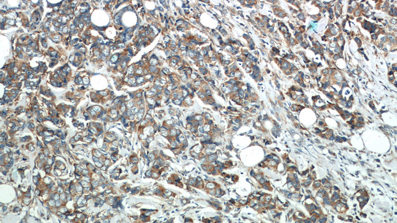 Immunohistochemistry of paraffin-embedded human breast cancer slide using Catalog No:115860 (TAZ Antibody) at dilution of 1:50 (under 10x lens)