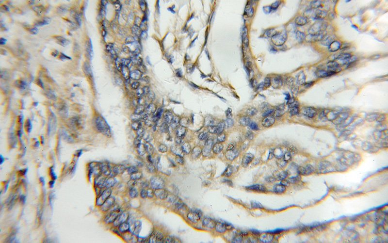 Immunohistochemical of paraffin-embedded human pancreas cancer using Catalog No:114314(PTPMT1 antibody) at dilution of 1:50 (under 10x lens)
