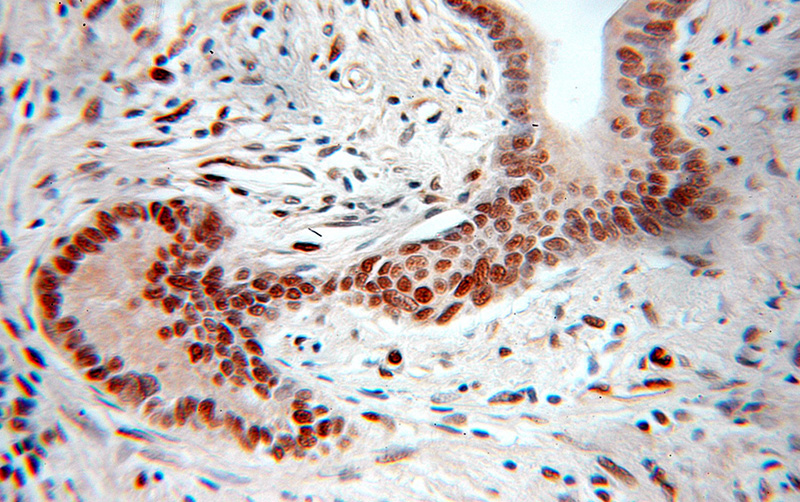 Immunohistochemical of paraffin-embedded human pancreas cancer using Catalog No:113790(PGM2 antibody) at dilution of 1:100 (under 10x lens)