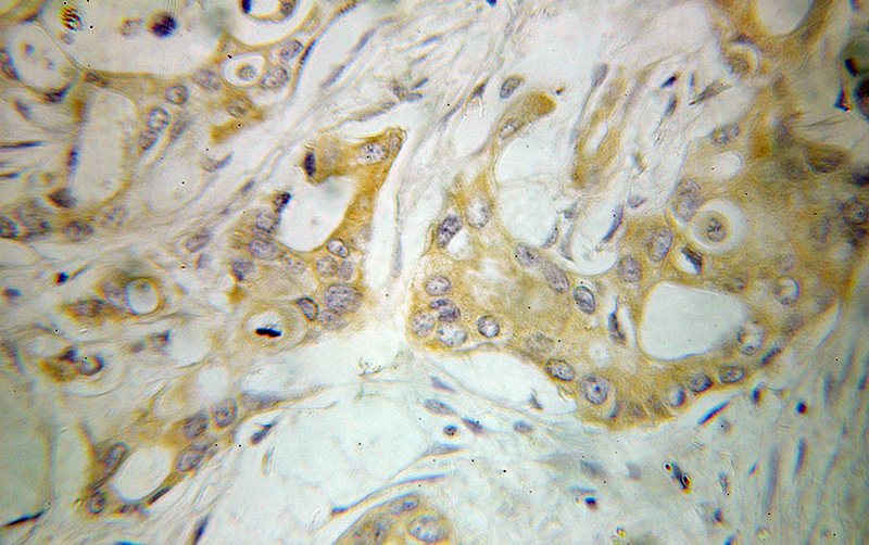 Immunohistochemical of paraffin-embedded human pancreas cancer using Catalog No:113955(PLEKHA1 antibody) at dilution of 1:100 (under 25x lens)
