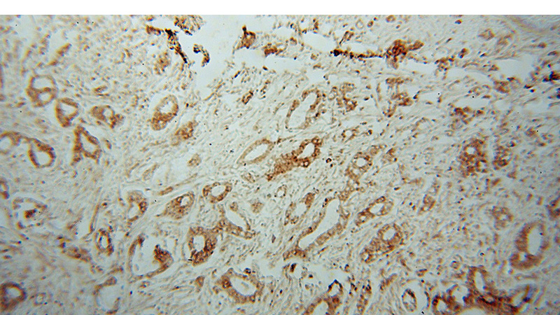 Immunohistochemical of paraffin-embedded human breast cancer using Catalog No:116451(ERP44 antibody) at dilution of 1:100 (under 10x lens)