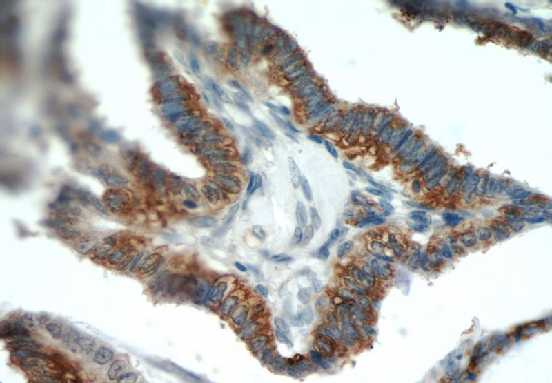 Immunohistochemical of paraffin-embedded human ovary tumor using Catalog No:109943(DIO1 antibody) at dilution of 1:50 (under 40x lens)