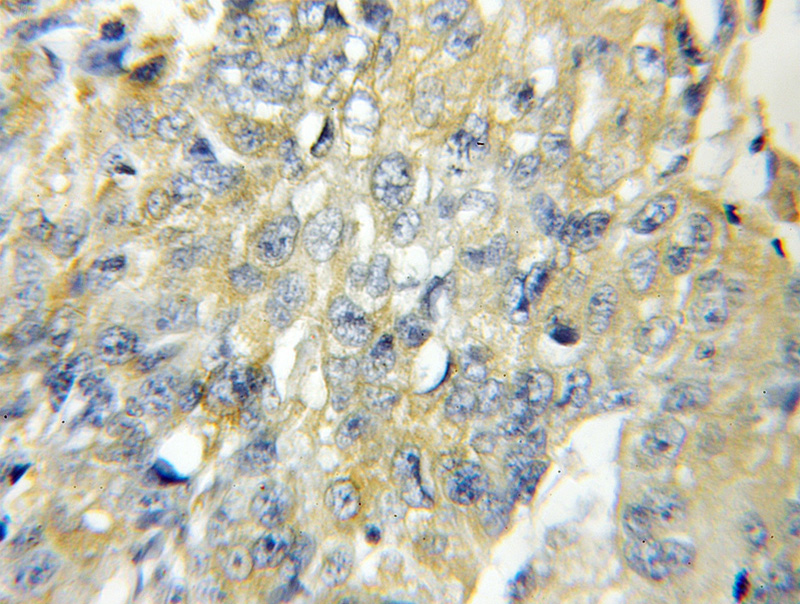 Immunohistochemical of paraffin-embedded human lung cancer using Catalog No:112422(MAP4 antibody) at dilution of 1:50 (under 10x lens)