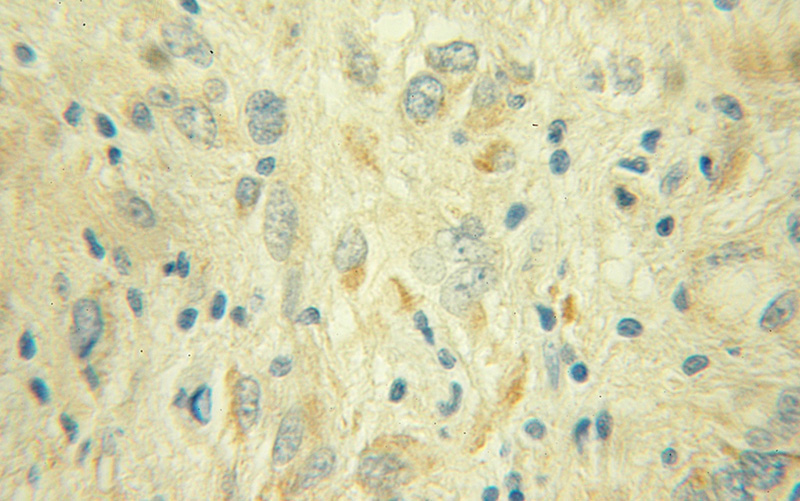 Immunohistochemical of paraffin-embedded human gliomas using Catalog No:113081(NDUFS1 antibody) at dilution of 1:50 (under 10x lens)