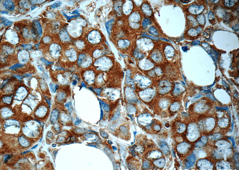 Immunohistochemistry of paraffin-embedded human breast cancer slide using Catalog No:114836(RPS25 Antibody) at dilution of 1:50